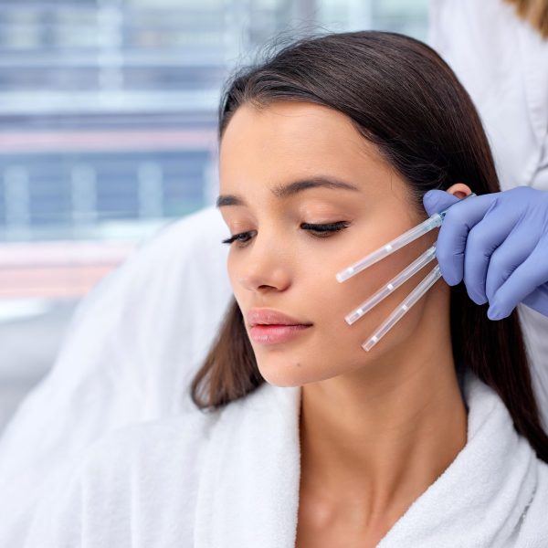 Lifting Facial cu Fire Resorbabile PDO